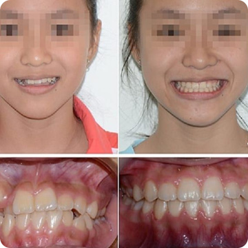 Niềng răng thành công là như thế nào? 1 Niềng răng thành công là như thế nào? 1