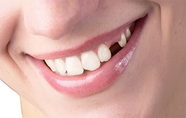 Tại sao răng 4r4 cần được nhổ?