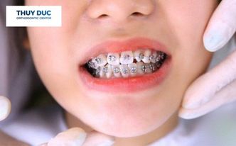 Niềng răng mắc cài kim loại 1