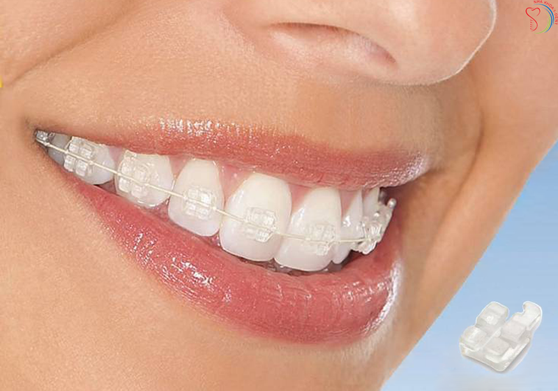 Niềng răng mắc cài sứ 1 Niềng răng mắc cài sứ 1