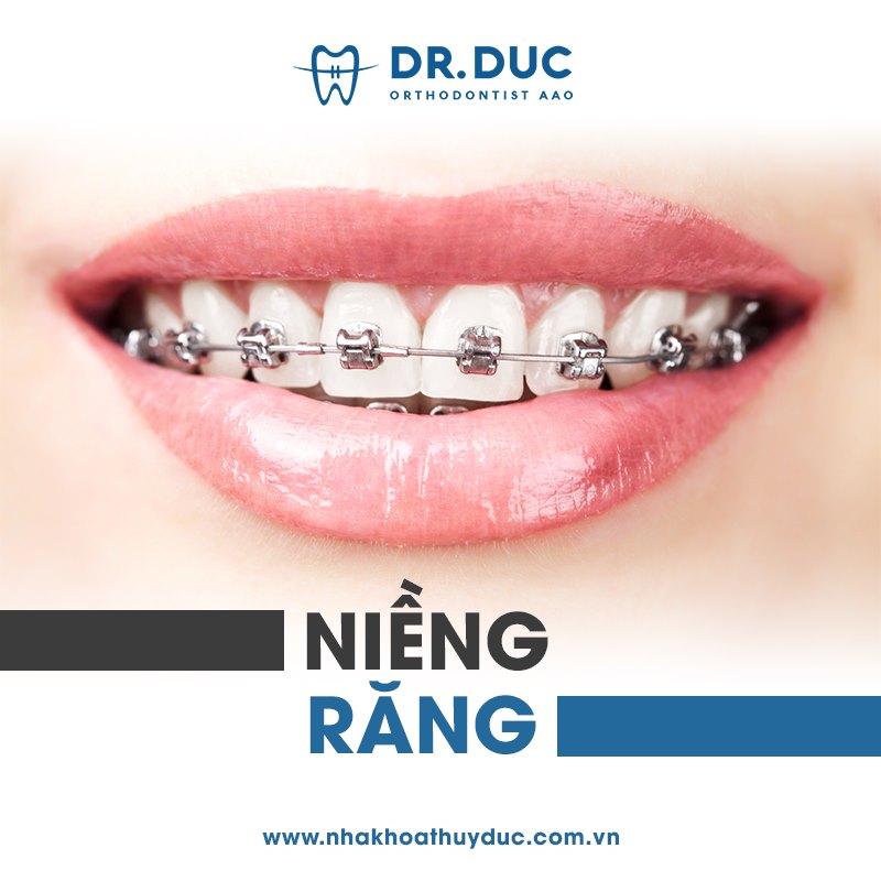 Niềng răng là gì? 1 Niềng răng là gì? 1