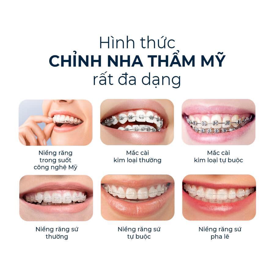 Niềng răng mắc cài sứ tự buộc 1