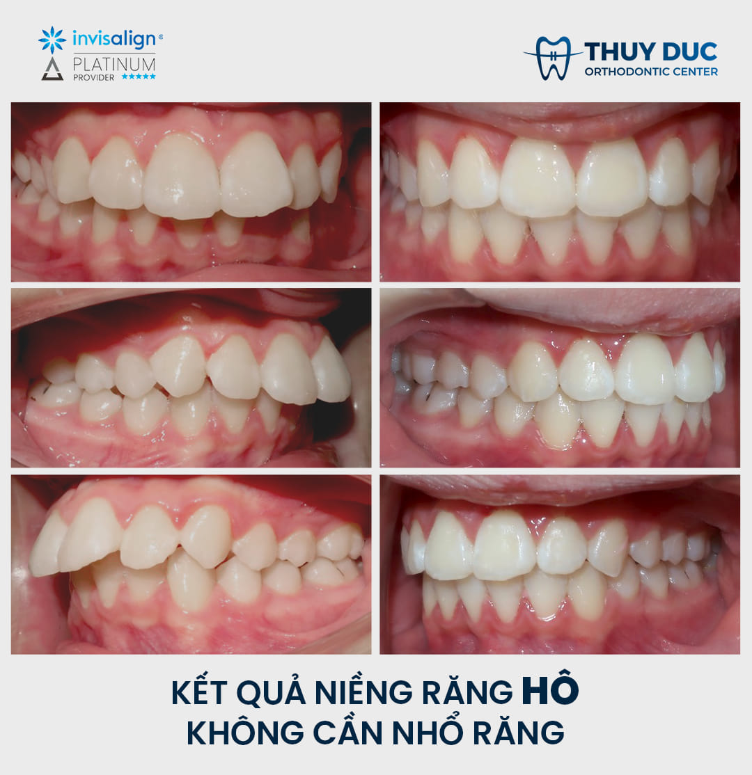Kết quả niềng răng không cần nhổ răng bởi bác sĩ Đức AAO 1 Kết quả niềng răng không cần nhổ răng bởi bác sĩ Đức AAO 1