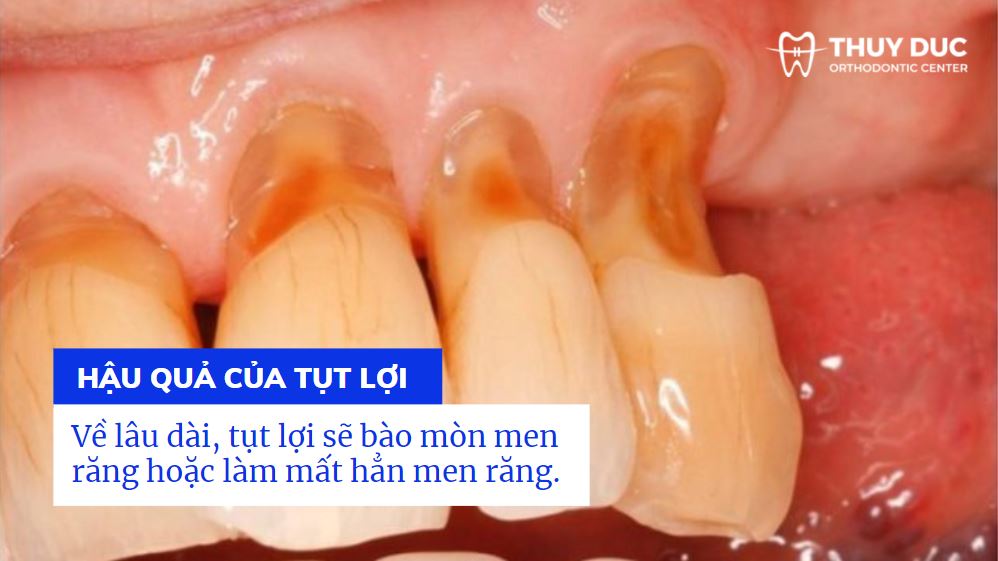 Tụt lợi có thể để lại hậu quả gì? 1 Tụt lợi có thể để lại hậu quả gì? 1