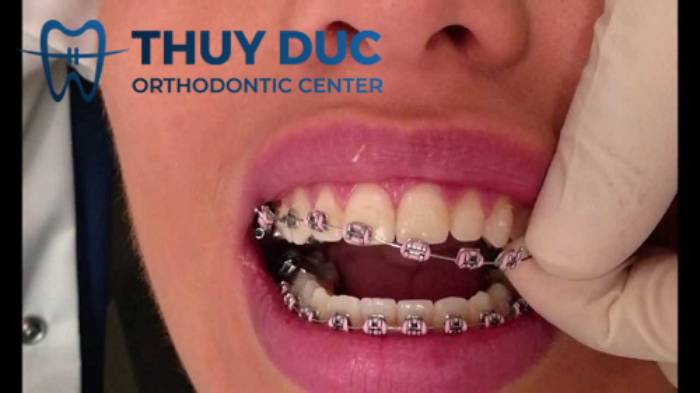 1. Dây cung bị tụt 1 1. Dây cung bị tụt 1