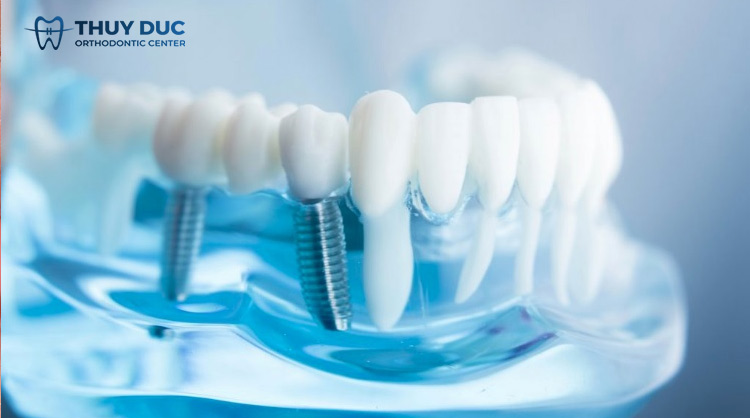 2.2. Những người gắn răng giả, bọc răng sứ 1 2.2. Những người gắn răng giả, bọc răng sứ 1