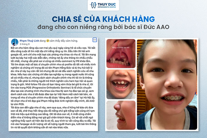 Niềng răng với mắc cài thông minh Damon Hoa Kỳ 5