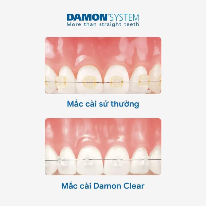 Niềng răng với mắc cài thông minh Damon Hoa Kỳ 1