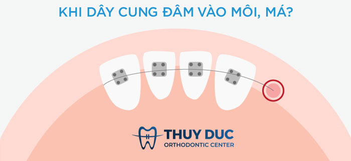 2. Dây cung đâm vào má 1 2. Dây cung đâm vào má 1
