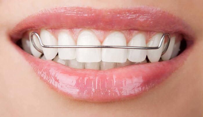 Hàm duy trì tháo lắp 3 Hàm duy trì tháo lắp 3