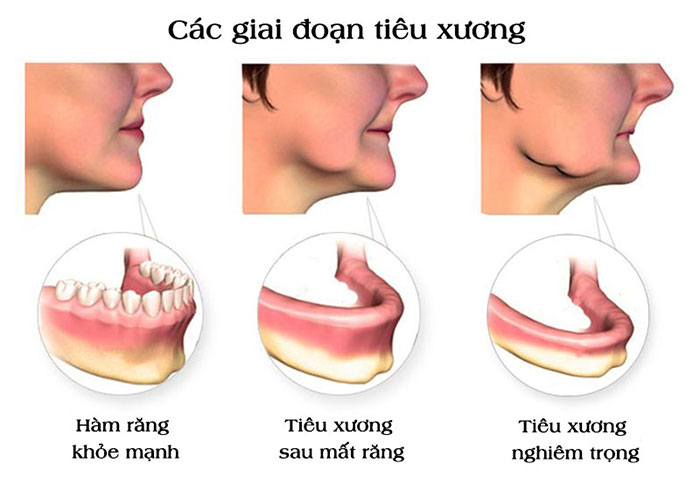 Bị tiêu xương hàm 1