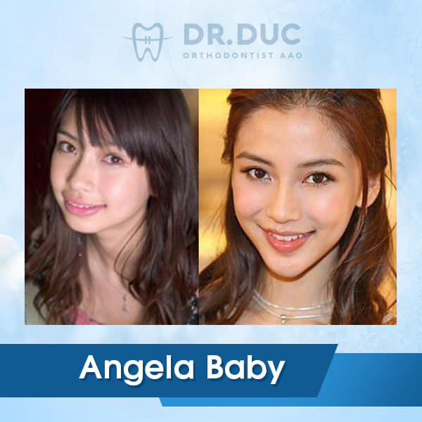 Hình ảnh niềng răng của người nổi tiếng 1