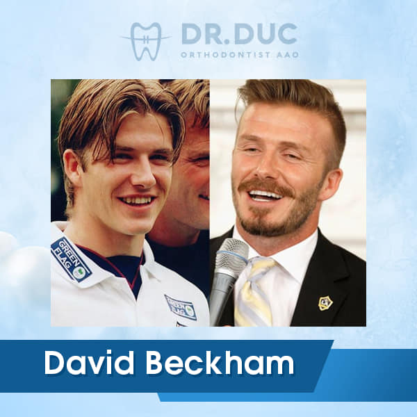 Hình ảnh niềng răng của người nổi tiếng 6