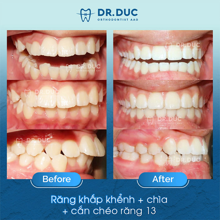 Các tình trạng răng phù hợp để chỉnh nha 1 Các tình trạng răng phù hợp để chỉnh nha 1