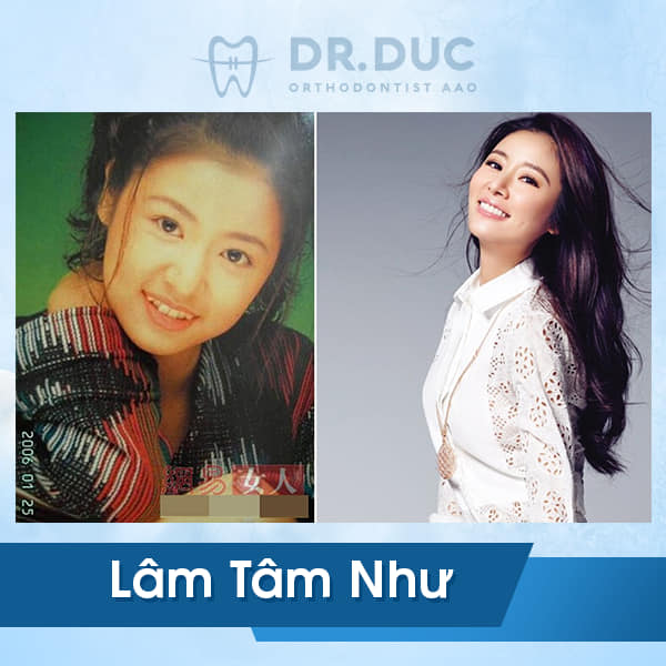 Hình ảnh niềng răng của người nổi tiếng 2