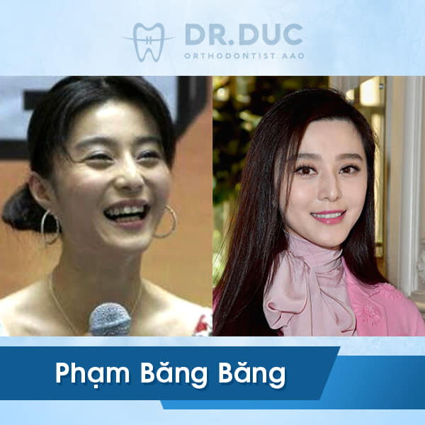 Hình ảnh niềng răng của người nổi tiếng 3