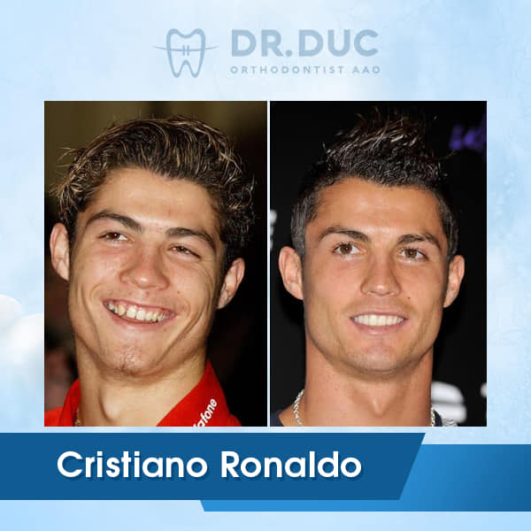 Hình ảnh niềng răng của người nổi tiếng 7