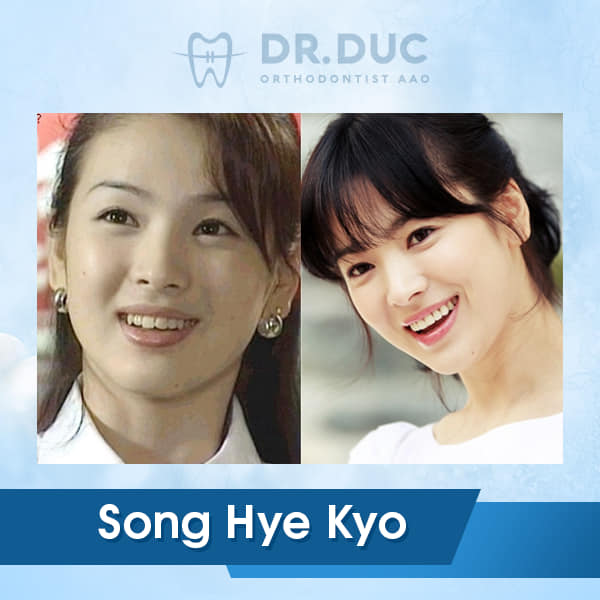 Hình ảnh niềng răng của người nổi tiếng 4