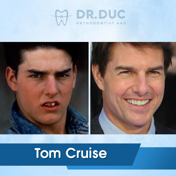Hình ảnh niềng răng của người nổi tiếng 5