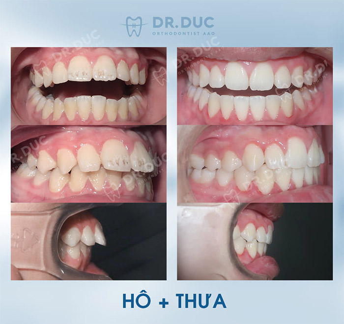 Các tình trạng răng phù hợp để chỉnh nha 2 Các tình trạng răng phù hợp để chỉnh nha 2