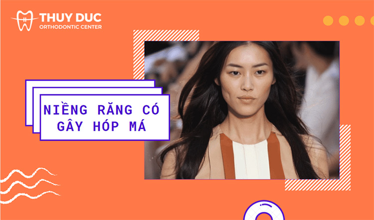 Sự thật về niềng răng gây hóp má, làm gò má cao hơn 1