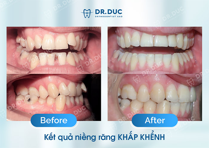 Hình ảnh trước - sau khi niềng răng chen chúc, khấp khểnh 4