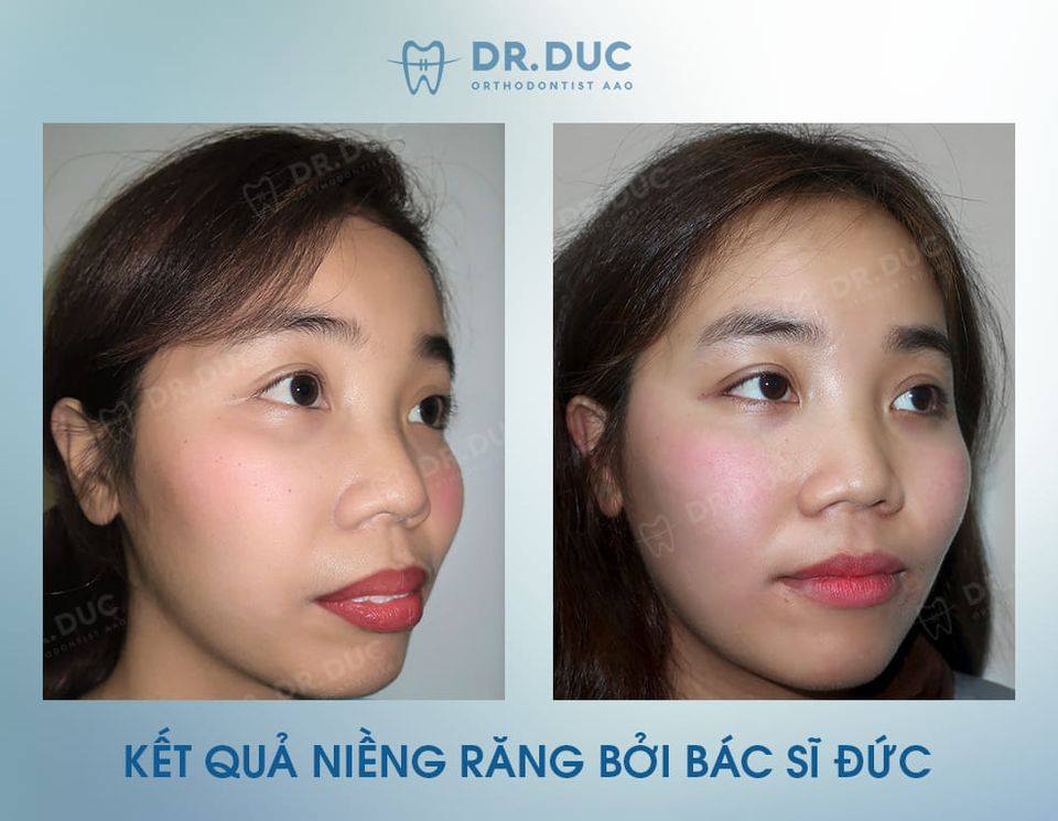 Phương pháp điều trị khớp cắn sâu 1 Phương pháp điều trị khớp cắn sâu 1