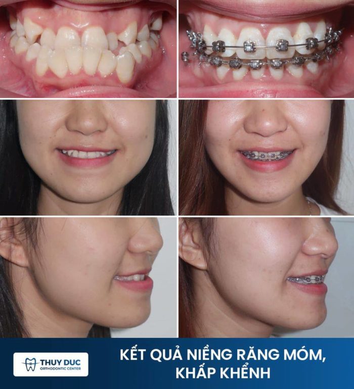 Trường hợp răng móm do răng 1