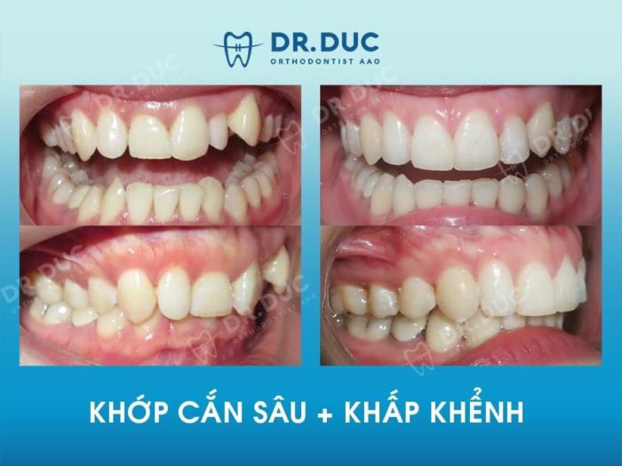 Đặc điểm nhận biết khớp cắn sâu 1 Đặc điểm nhận biết khớp cắn sâu 1