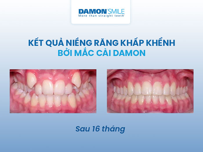 Niềng răng với mắc cài thông minh Damon Hoa Kỳ 2