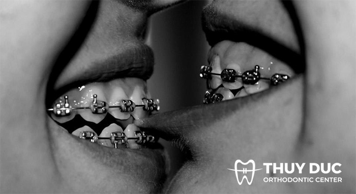 Những câu hỏi thường gặp về hôn với niềng răng 1