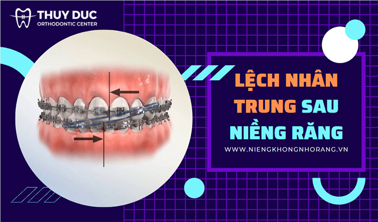 Cách ngăn chặn và khắc phục tình trạng lệch nhân trung sau khi niềng răng 1 Cách ngăn chặn và khắc phục tình trạng lệch nhân trung sau khi niềng răng 1