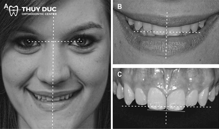 Lệch nhân trung sau khi chỉnh nha là do đâu? 1 Lệch nhân trung sau khi chỉnh nha là do đâu? 1