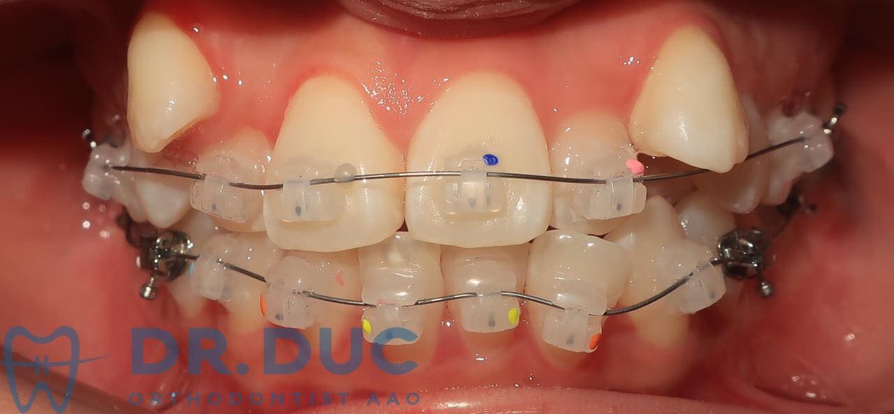 Niềng răng mắc cài sứ tự buộc tại Nha khoa Thúy Đức 1