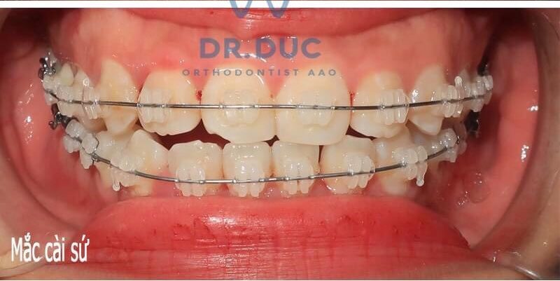 Niềng răng bằng mắc cài sứ 1 Niềng răng bằng mắc cài sứ 1