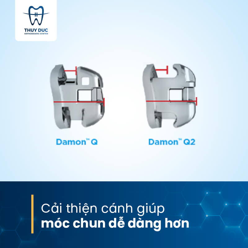 Phương pháp niềng răng với mắc cài thông minh Damon 1 Phương pháp niềng răng với mắc cài thông minh Damon 1