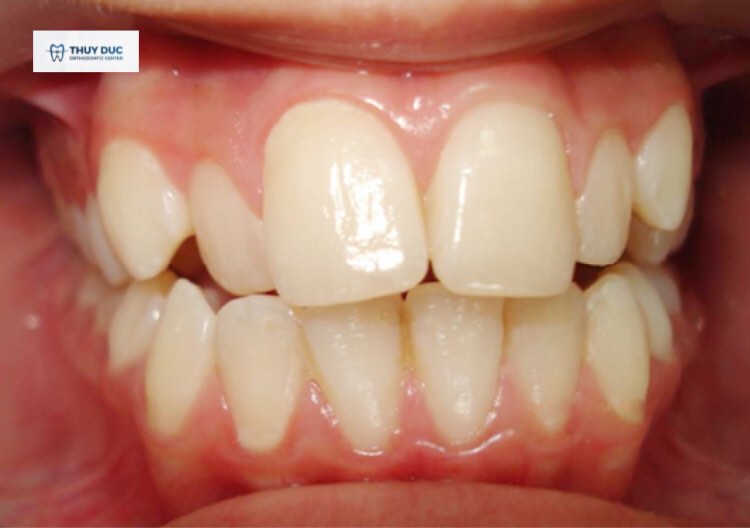 Răng cửa bị hô 1