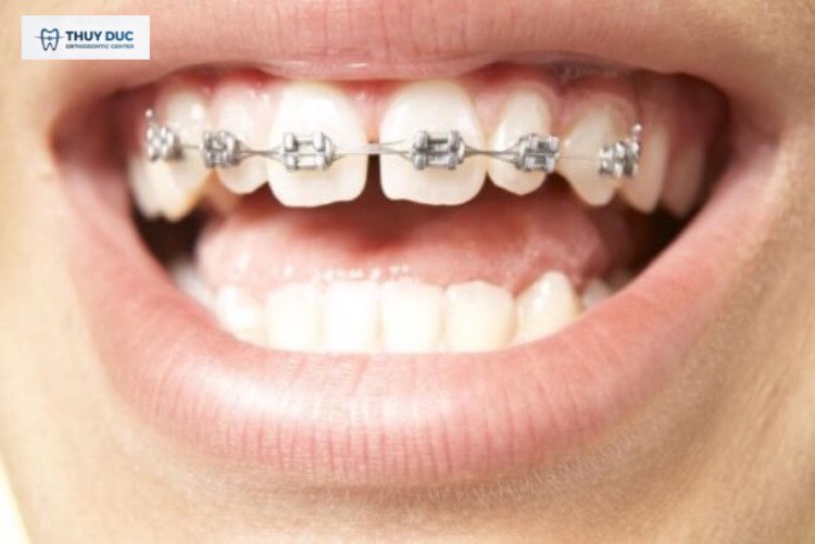 Niềng 2 răng cửa có hiệu quả không? 1