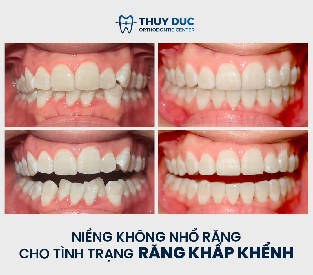 4. Quy trình thực hiện niềng răng không nhổ