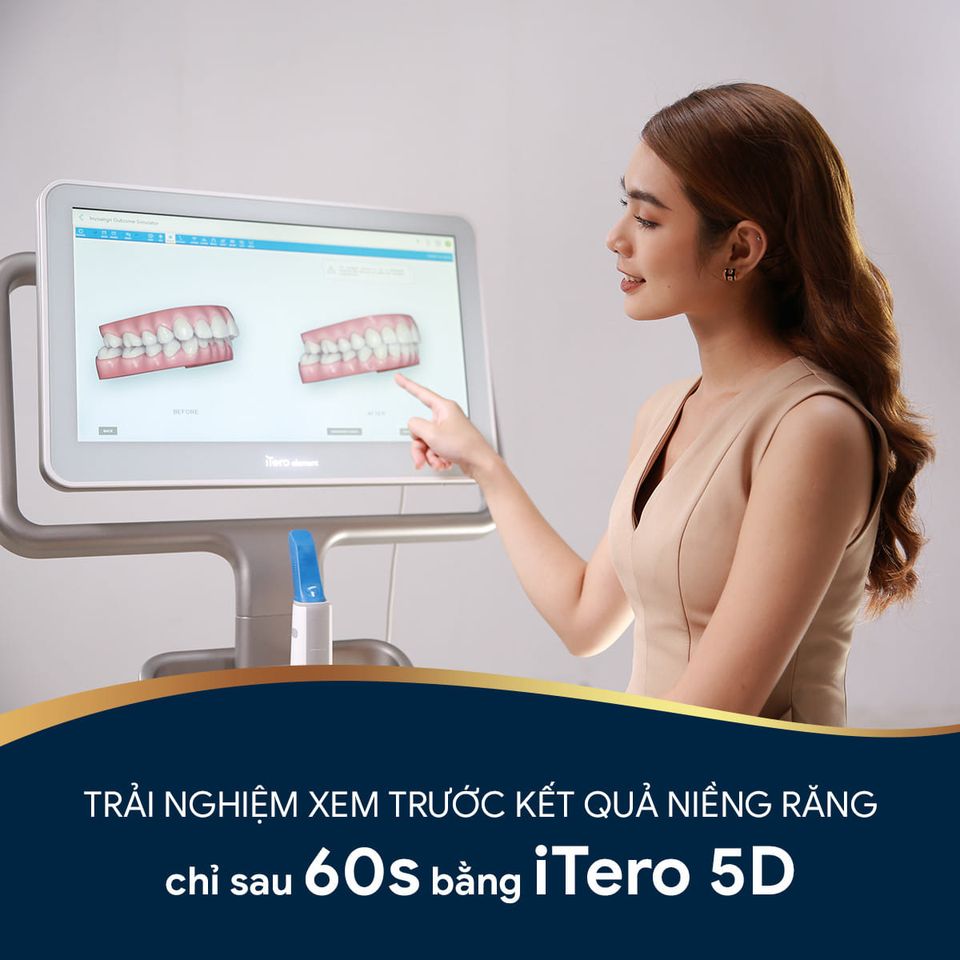 Chi phí niềng răng không mắc cài 1 Chi phí niềng răng không mắc cài 1