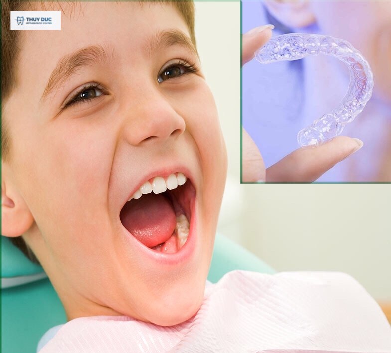 Sự khác biệt giữa niềng răng không nhổ răng so với các phương pháp khác 2 Sự khác biệt giữa niềng răng không nhổ răng so với các phương pháp khác 2