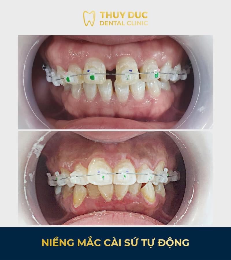 Đối với niềng răng bằng mắc cài sứ 1 Đối với niềng răng bằng mắc cài sứ 1