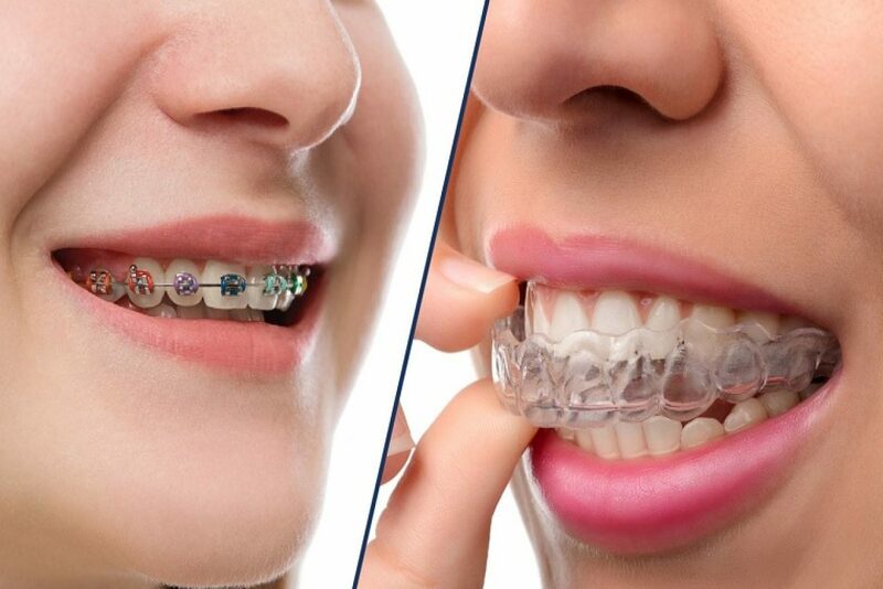 Bạn nên chọn niềng răng truyền thống hay Invisalign?