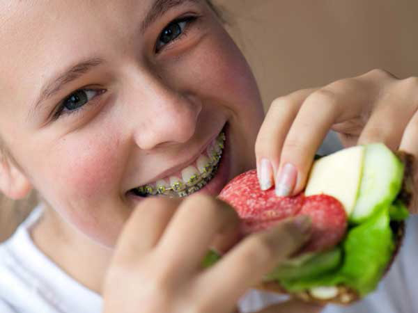 Niềng răng bao lâu thì được ăn uống bình thường? 1 Niềng răng bao lâu thì được ăn uống bình thường? 1