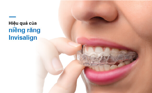 Niềng răng trong suốt Invisalign là gì? 1