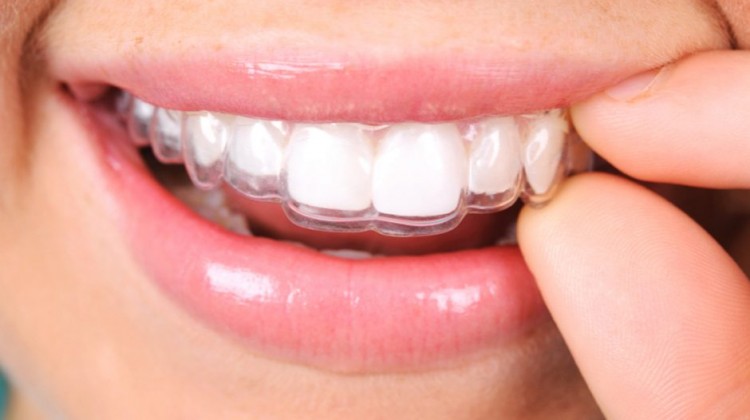 Hàm duy trì tháo lắp 2 Hàm duy trì tháo lắp 2