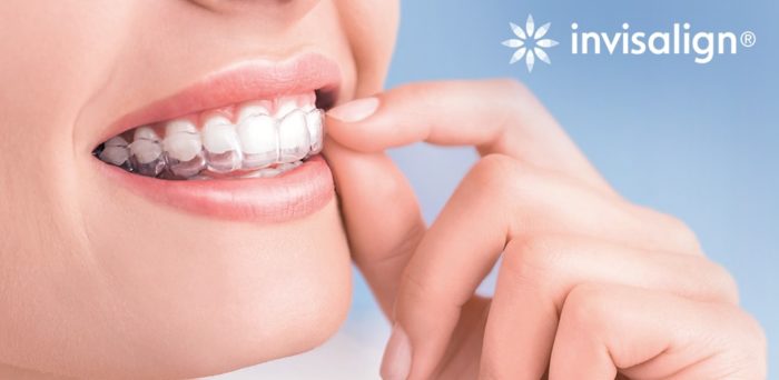 Niềng răng thưa nhanh và hiệu quả với Invisalign tại Nha khoa Thúy Đức 1 Niềng răng thưa nhanh và hiệu quả với Invisalign tại Nha khoa Thúy Đức 1