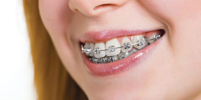 Nhận biết niềng răng hỏng và cách sửa chữa 1
