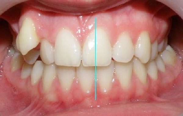 Bị lệch mặt, lệch nhân trung 1 Bị lệch mặt, lệch nhân trung 1