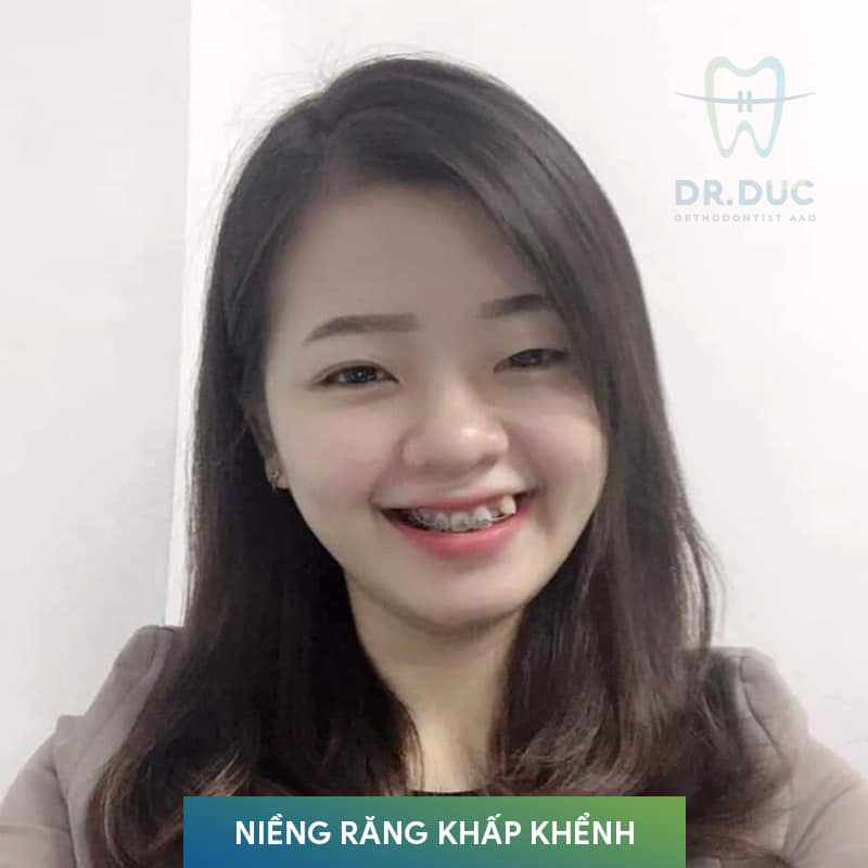 Đối với phương pháp niềng răng 1 Đối với phương pháp niềng răng 1